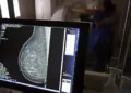 Câncer de mama: exame preventivo precisa ser feito a partir de 40 anos
