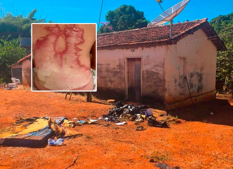 PC investiga incidente que deixou jovem com graves queimaduras por todo o corpo, em Retiro da Roça